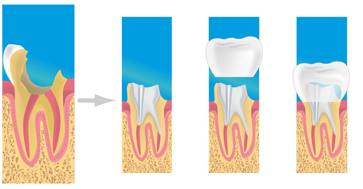 prothese dentaire haguenau 