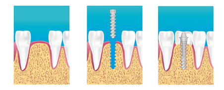 implant dentaire haguenau