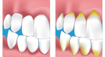 parodontie dentaire haguenau